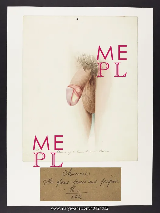: Chancre of Glans Penis and Prepuce : Chancre of Glans Penis and Prepuce