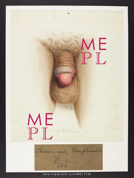 : Chancre and Paraphimosis : Chancre and Paraphimosis