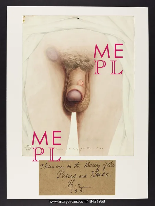 : Chancre on Penis, Bubo : Chancre on Penis, Bubo