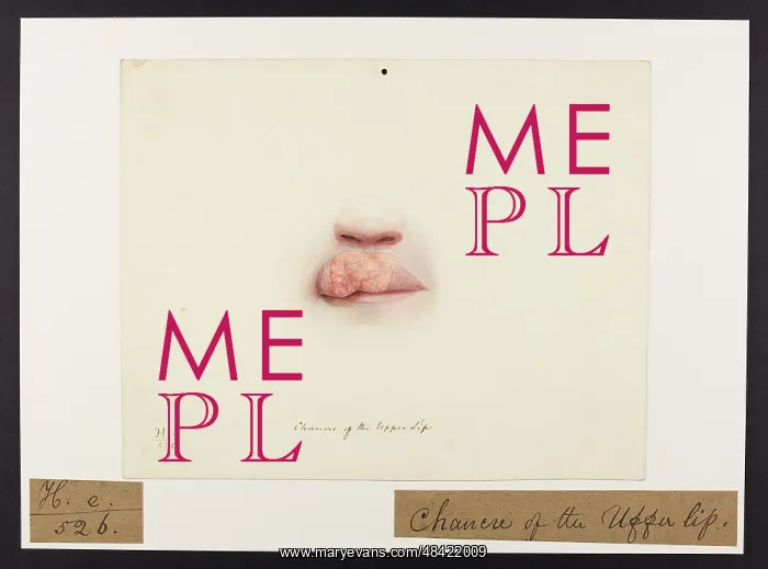 : Chancre of Upper Lip : Chancre of Upper Lip