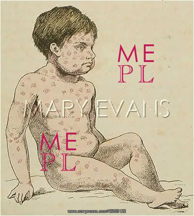 : CHILD WITH MEASLES / 1883 : CHILD WITH MEASLES / 1883