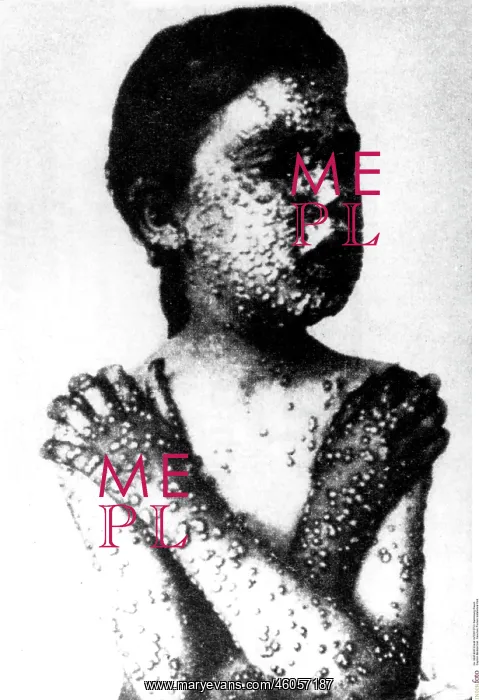: Child with smallpox : Child with smallpox