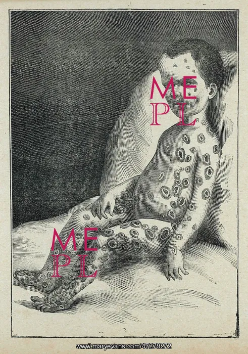 : Child with Smallpox : Child with Smallpox