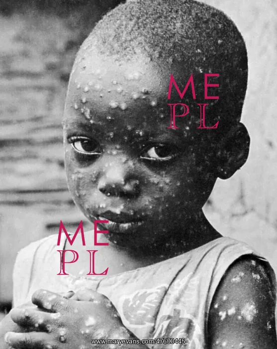 : Child With Smallpox : Child With Smallpox