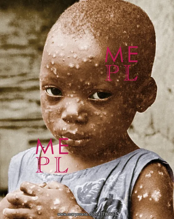 : Child With Smallpox : Child With Smallpox