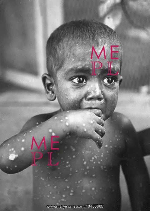: A child with Smallpox, Infectious Diseases Hospital : A child with Smallpox, Infectious Diseases Hospital