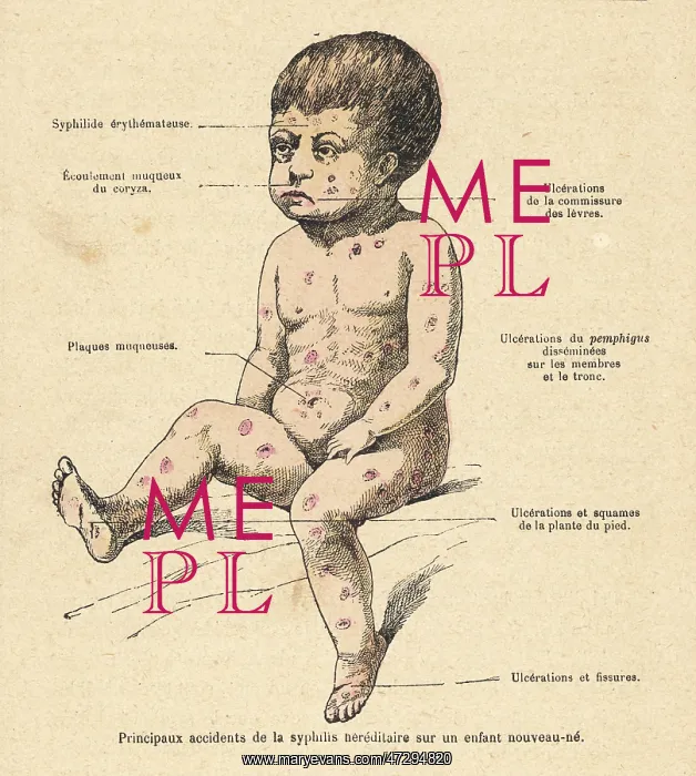 : CHILD WITH SYPHILIS : CHILD WITH SYPHILIS