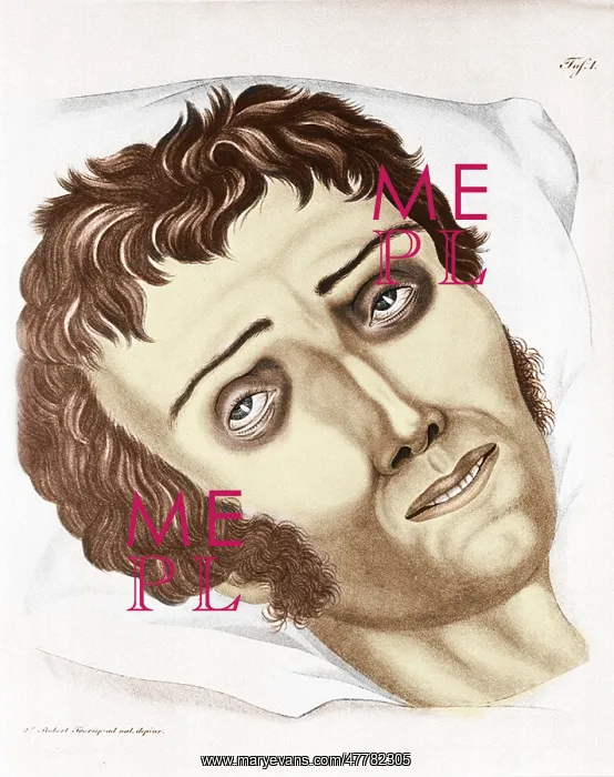 : Cholera Victim, 1831 : Cholera Victim, 1831