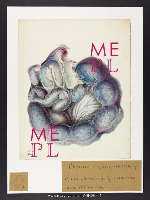 : Chronic Inflammation of Serous Membrane of Intestines : Chronic Inflammation of Serous Membrane of Intestines