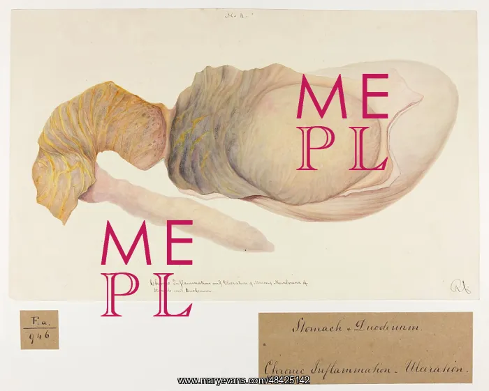 : Chronic Inflammation and Ulceration of Stomach and Duodenum : Chronic Inflammation and Ulceration of Stomach and Duodenum