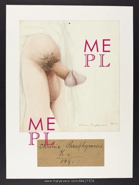 : Chronic Paraphimosis : Chronic Paraphimosis