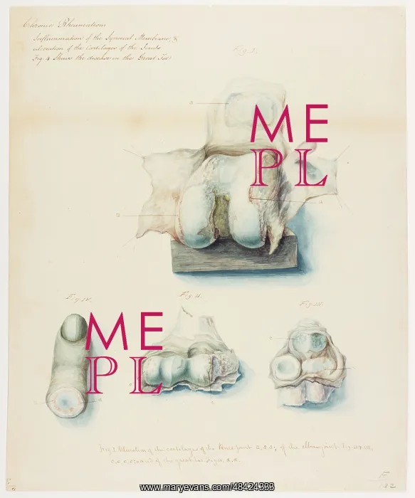 : Chronic rheumatism : Chronic rheumatism