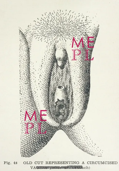 : CIRCUMCISION 1775 : CIRCUMCISION 1775