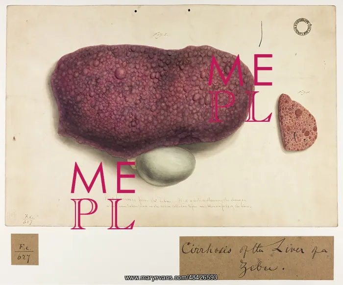 : Cirrhosis of Liver of a Zebu : Cirrhosis of Liver of a Zebu