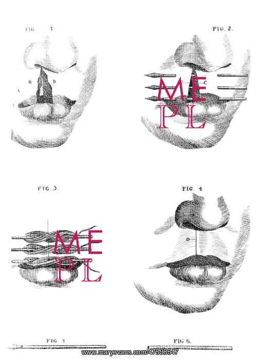 : Cleft Lip Surgery, 1791 : Cleft Lip Surgery, 1791