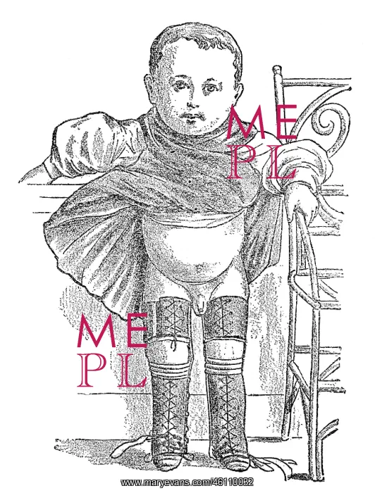 : Clubfoot during therapy, 1902 : Clubfoot during therapy, 1902