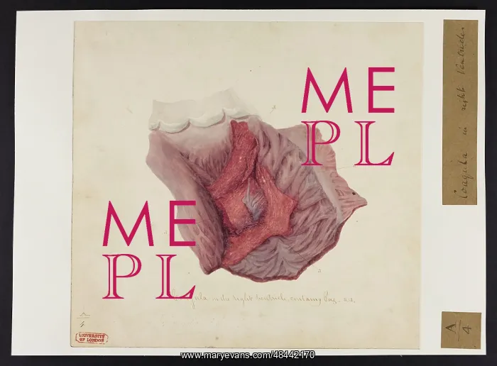  : Coagula in Right Ventricle