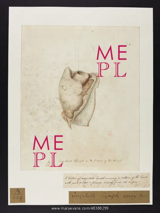 : Coagulable Lymph Covering Heart : Coagulable Lymph Covering Heart