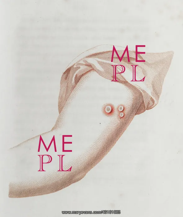 : Coloured depiction of lesion on arm : Coloured depiction of lesion on arm