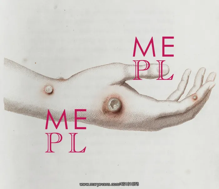 : Coloured depiction of lesion on a hand : Coloured depiction of lesion on a hand