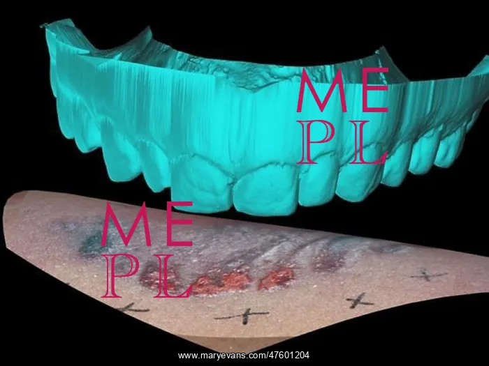 : Computer Reconstruction of Bite Mark : Computer Reconstruction of Bite Mark