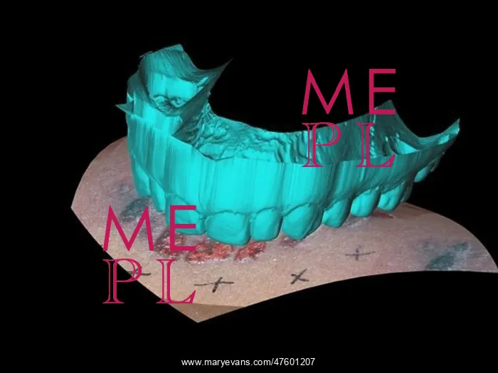 : Computer Reconstruction of Bite Mark : Computer Reconstruction of Bite Mark