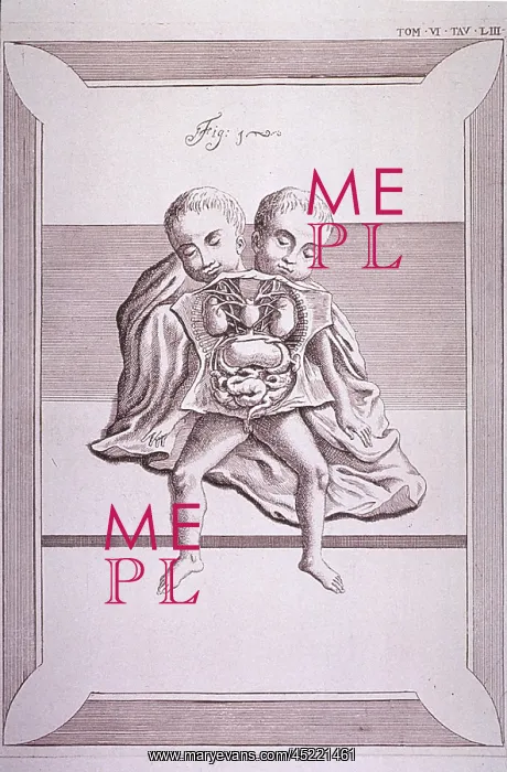 : Conjoined twins with common torso and limbs, ? : Conjoined twins with common torso and limbs, ?