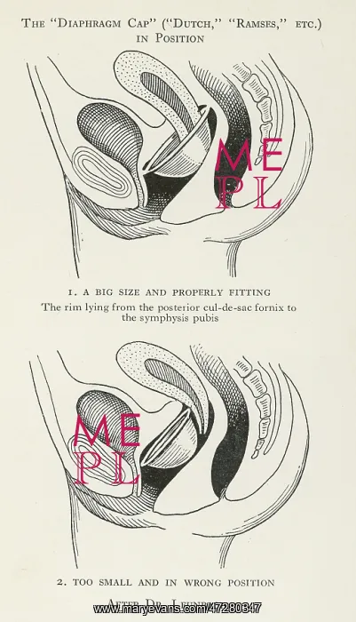 : CONTRACEPTION / DIAPHRAGM : CONTRACEPTION / DIAPHRAGM
