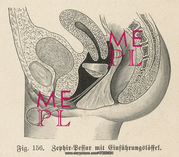 : CONTRACEPTION / ZEPHIR CAP : CONTRACEPTION / ZEPHIR CAP