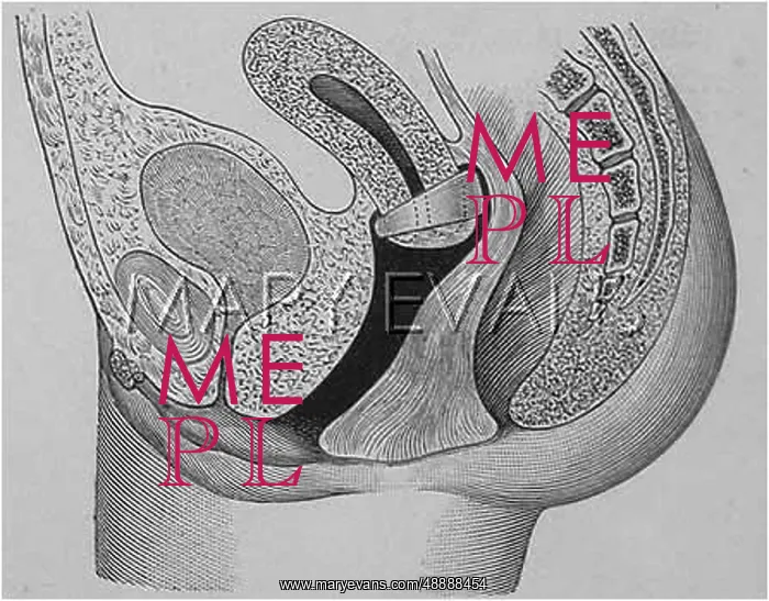 : CONTRACEPTION / ZEPHIR CAP : CONTRACEPTION / ZEPHIR CAP
