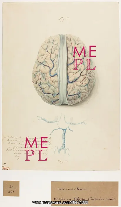 : Convolutions of brain: atrophy and oedema : Convolutions of brain: atrophy and oedema