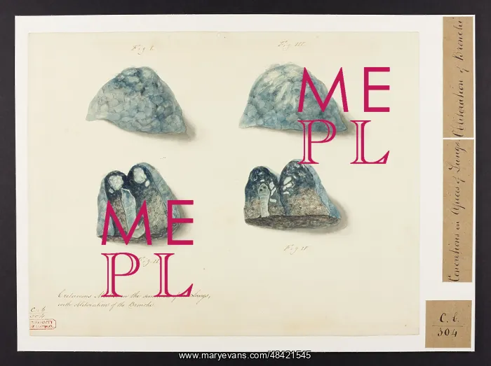 : Cretaceous Matter in the Summits of the Lungs : Cretaceous Matter in the Summits of the Lungs