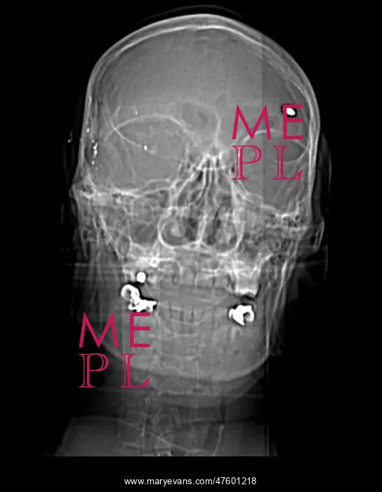 : CT Scout View, Bullet Fragments : CT Scout View, Bullet Fragments