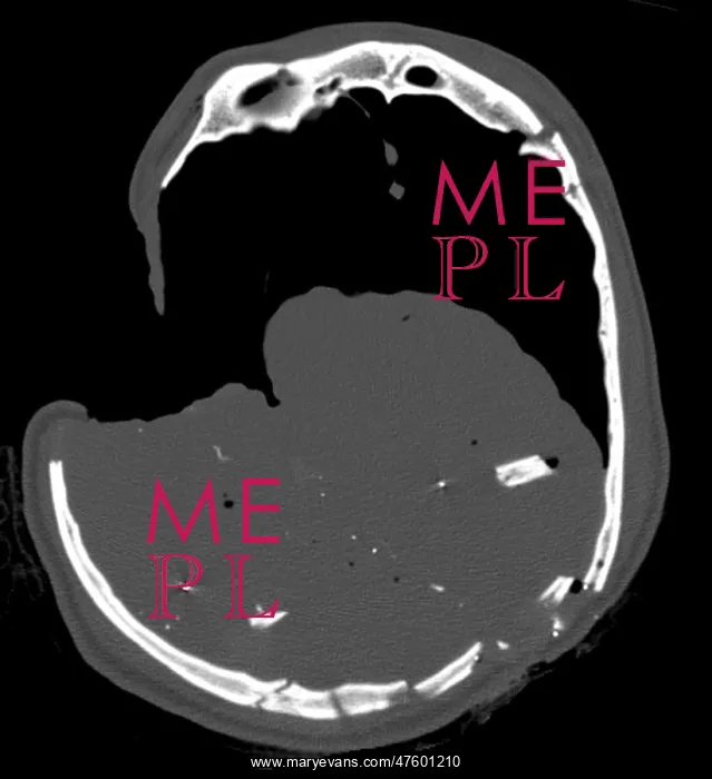 : CT Section, Gunshot Wound : CT Section, Gunshot Wound