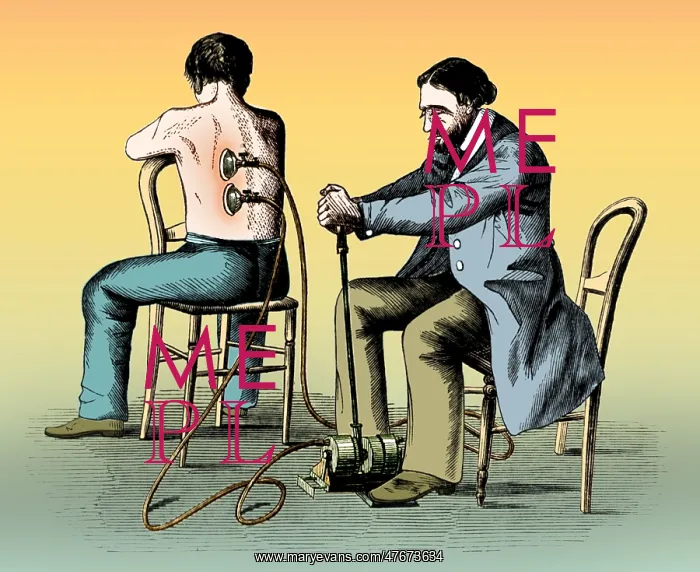 : Cupping Therapy, 1862 : Cupping Therapy, 1862