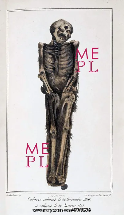 : Decomposition On Exhumed Bodies, 1831 : Decomposition On Exhumed Bodies, 1831