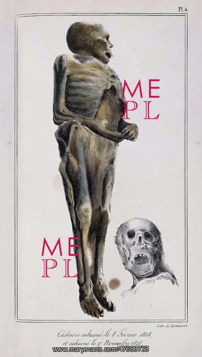 : Decomposition On Exhumed Bodies, 1831 : Decomposition On Exhumed Bodies, 1831
