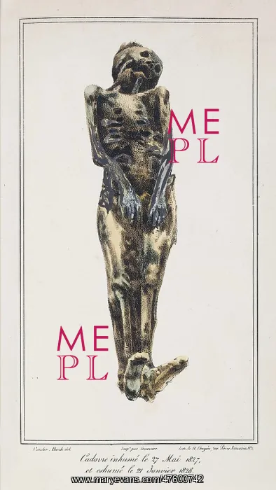 : Decomposition On Exhumed Bodies, 1831 : Decomposition On Exhumed Bodies, 1831