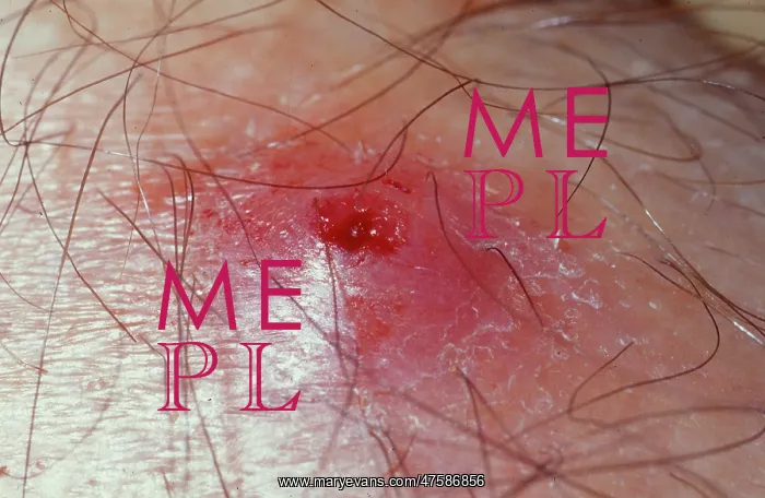 : Dermatobia hominis, human botfly : Dermatobia hominis, human botfly