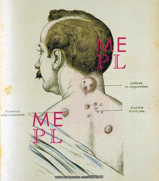 : Development of pustules in a man suffering from : Development of pustules in a man suffering from
