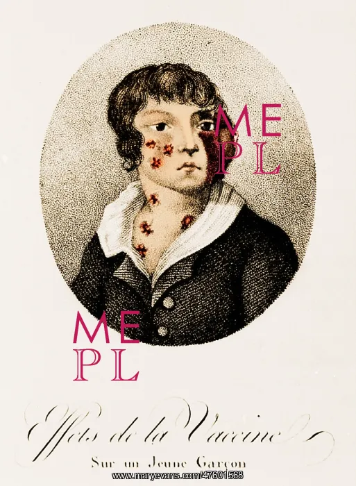 : Development of Smallpox after Vaccination, 1807 : Development of Smallpox after Vaccination, 1807