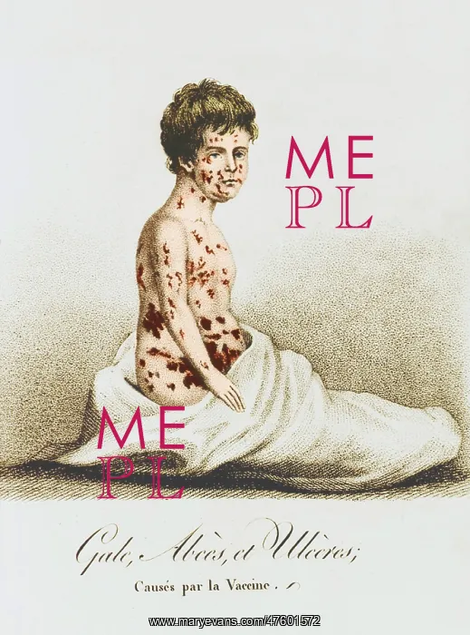  : Development of Smallpox after Vaccination, 1807
