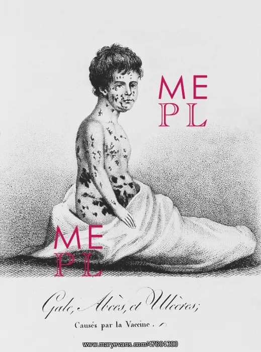 : Development of Smallpox after Vaccination, 1807 : Development of Smallpox after Vaccination, 1807