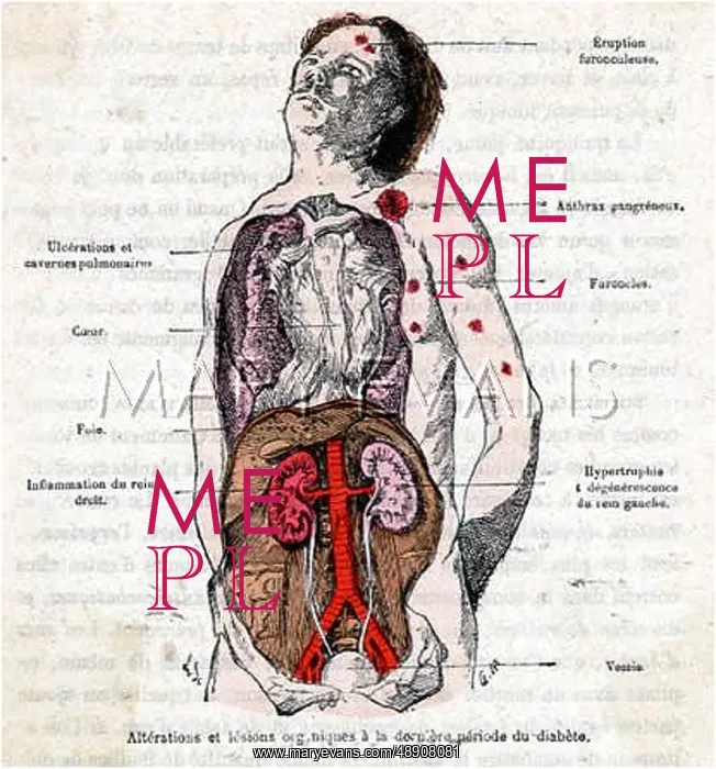  : DIABETES SUFFERER