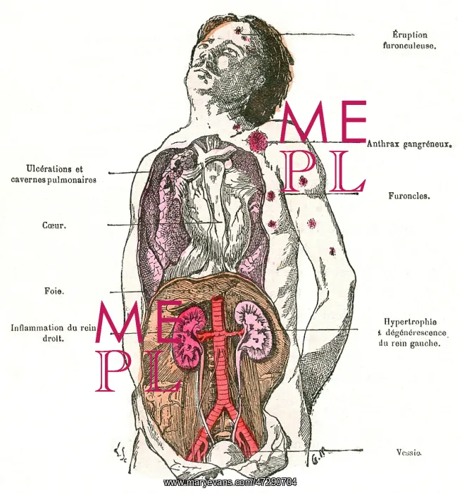 : DIAGRAM / DIABETES / 1883 : DIAGRAM / DIABETES / 1883