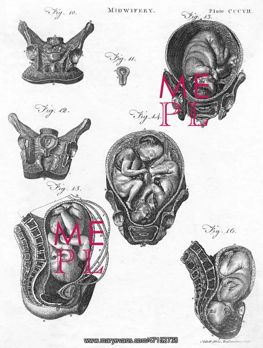  : Diagrams of foetuses in the womb