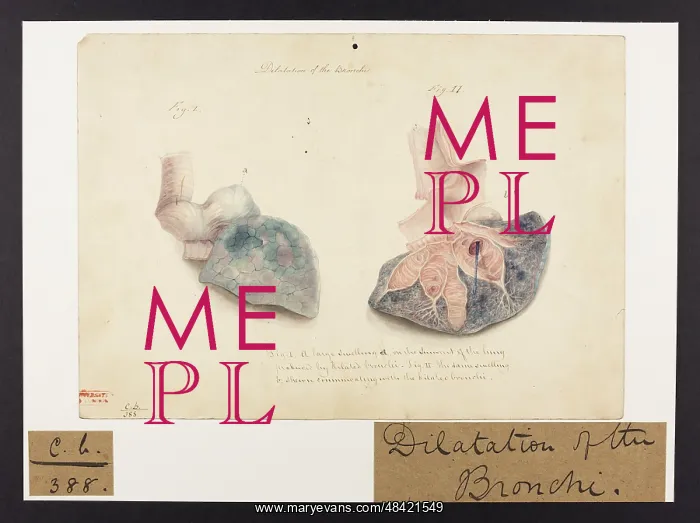 : Dilatation of the Bronchi : Dilatation of the Bronchi