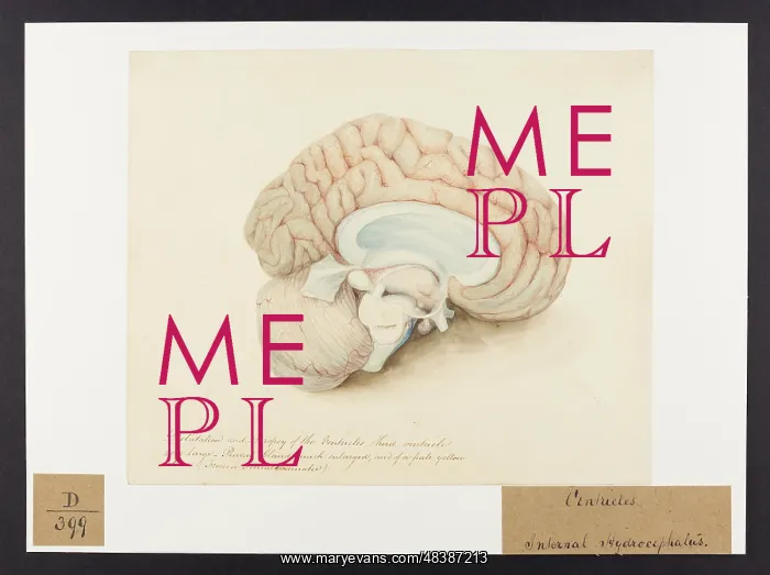 : Dilatation and Dropsy of the Ventricles : Dilatation and Dropsy of the Ventricles