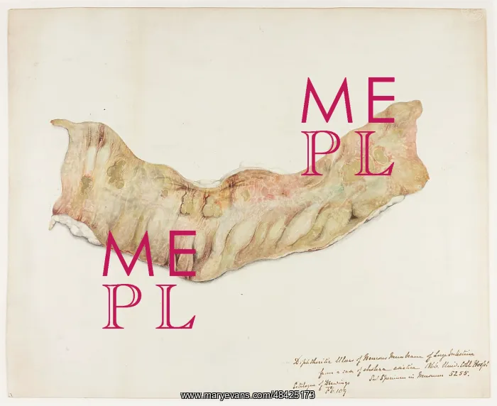: Diphtheric Ulcers of Mucous Membrane of Large Intestine : Diphtheric Ulcers of Mucous Membrane of Large Intestine