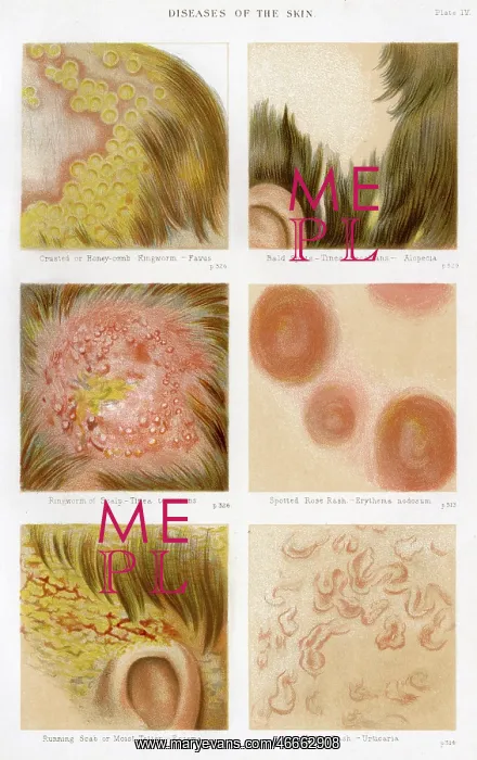 : Diseases of the Skin - Plate 4 : Diseases of the Skin - Plate 4
